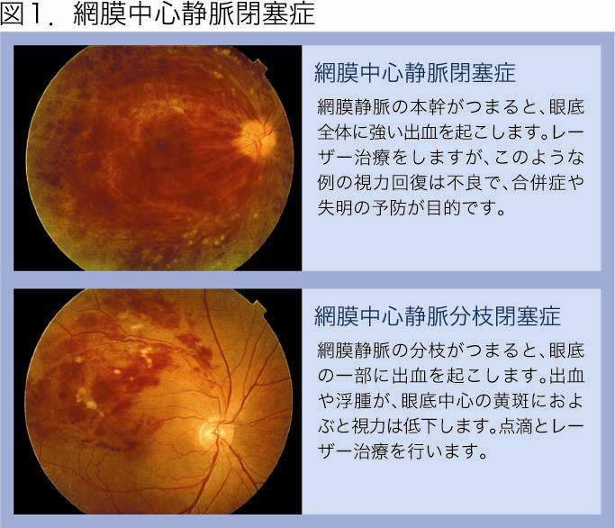 眼底 出血 初期 症状